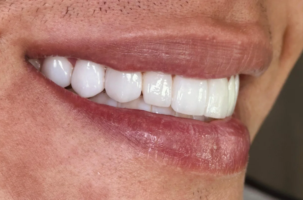 Patient smile transformation 1