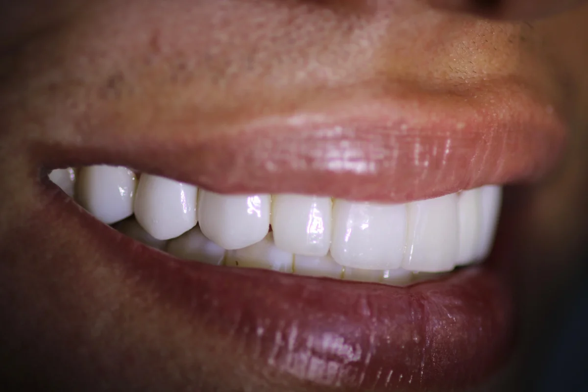 Patient smile transformation 2