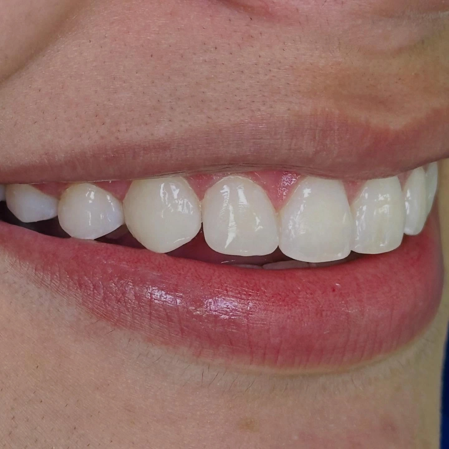 Patient smile transformation 5
