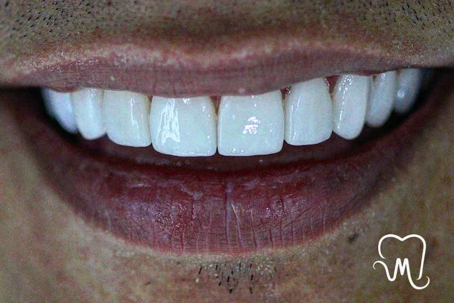 Patient smile transformation 6