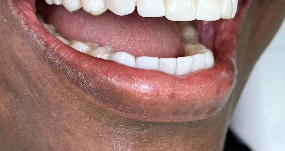 Patient smile transformation 7